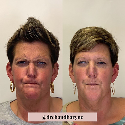 Before and After for Wrinkle Correction | Before and After | Rejuvenation MD Aesthetic | Asheboro, NC