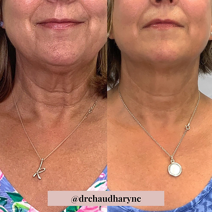 Before and After photo for neck wrinkle correction | Before and After | Rejuvenation MD Aesthetic | Asheboro, NC