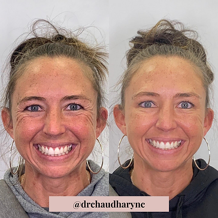 Wrinkle Correction for Face | Before and After | Rejuvenation MD Aesthetic | Asheboro, NC