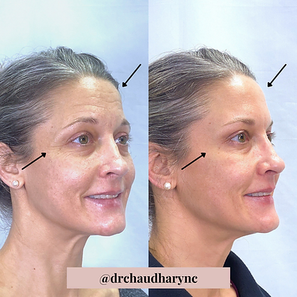 Wrinkles Correction around eyes and on forehead | Before and After | Rejuvenation MD Aesthetic | Asheboro, NC