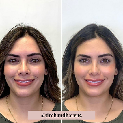 Smile wrinkles correction | Before and After | Rejuvenation MD Aesthetic | Asheboro, NC