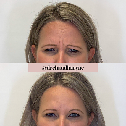 Head wrinkles correction | Before and After | Rejuvenation MD Aesthetic | Asheboro, NC