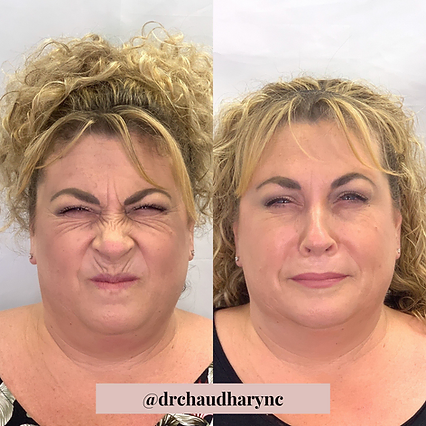 Wrinkle Correction for Face | Before and After | Rejuvenation MD Aesthetic | Asheboro, NC