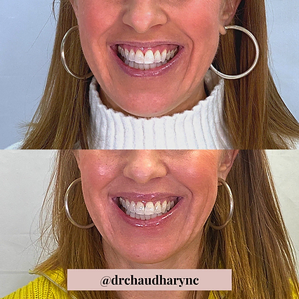 Wrinkle correction for smile lines | Before and After | Rejuvenation MD Aesthetic | Asheboro, NC