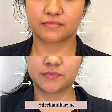 Lower Face Wrinkle correction | Before and After | Rejuvenation MD Aesthetic | Asheboro, NC