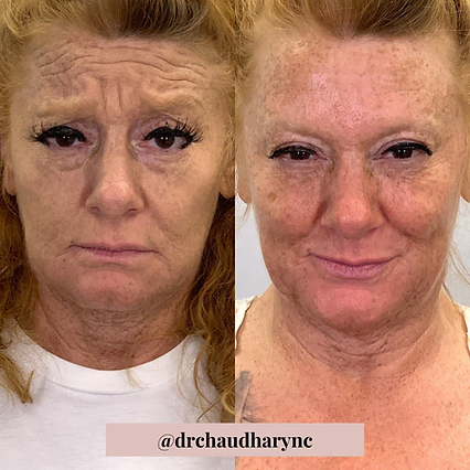 Wrinkle Correction for elderly woman | Before and After | Rejuvenation MD Aesthetic | Asheboro, NC