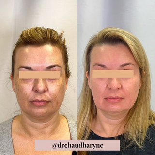 Chemical Peels Treatment | Rejuvenation MD Aesthetic | Asheboro, NC