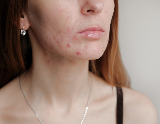 Acne Services | Rejuvenation MD Aesthetic | Asheboro, NC