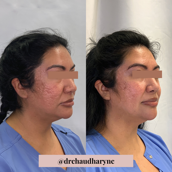 Co2 Laser Resurfacing before after | Rejuvenation MD Aesthetic | Asheboro, NC