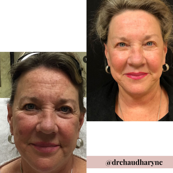 Co2 Laser Resurfacing before after | Rejuvenation MD Aesthetic | Asheboro, NC