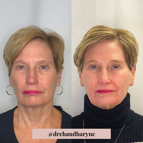 Co2 Laser Resurfacing before after | Rejuvenation MD Aesthetic | Asheboro, NC