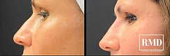 Collagen Growth With Sculptra® Aesthetic | Rejuvenation MD Aesthetic | Asheboro, NC