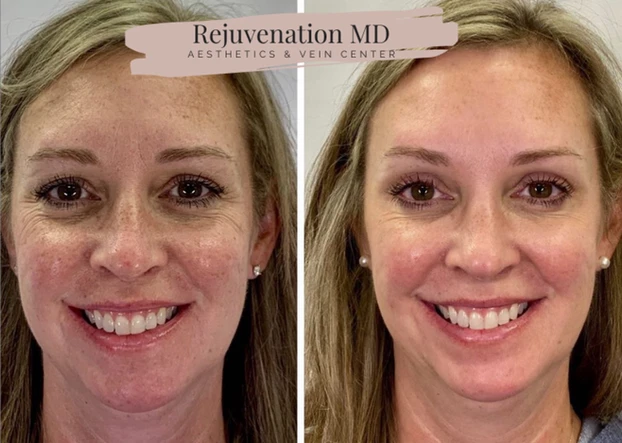 Cyspera® for Hyperpigmentation Before After Treatment | Rejuvenation MD Aesthetic | Asheboro, NC