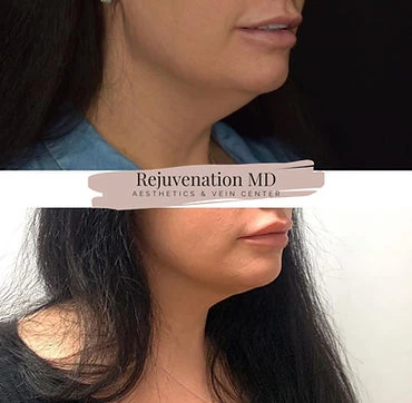 Double Chin Reduction After-vs-Before | Rejuvenation MD Aesthetic | Asheboro, NC