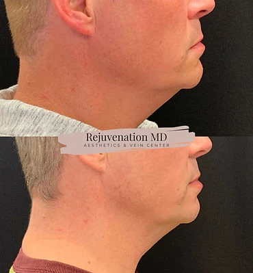 Double Chin Reduction After-vs-Before | Rejuvenation MD Aesthetic | Asheboro, NC