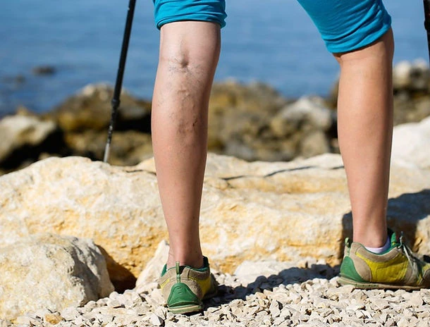 EVLA Varicose Veins Treatment | | Rejuvenation MD Aesthetic | Asheboro, NC