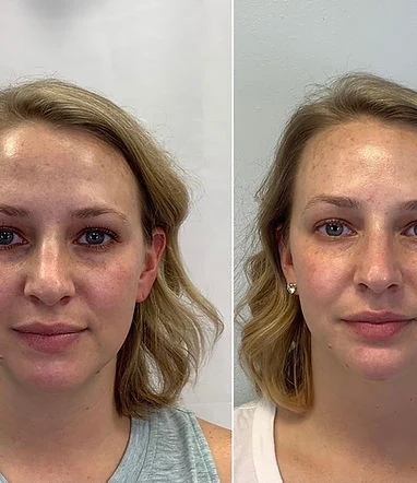 Full Facial Rejuvenation Before and After | Rejuvenation MD Aesthetic | Asheboro, NC