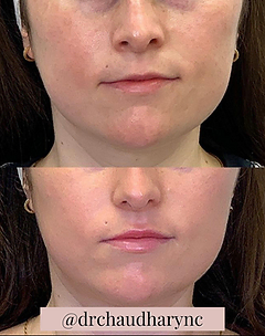 Lip Augmentation & Restoration After-vs-Before | Rejuvenation MD Aesthetic | Asheboro, NC