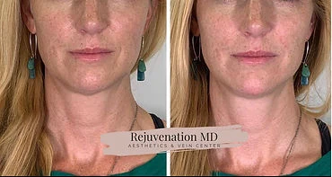 Lower Face Rejuvenation | Rejuvenation MD Aesthetic | Asheboro, NC