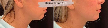 Lower Face Rejuvenation | Rejuvenation MD Aesthetic | Asheboro, NC