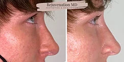 Non-Surgical Rhinoplasty Before-and-after | Rejuvenation MD Aesthetic | Asheboro, NC