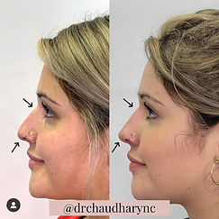 Non-Surgical Rhinoplasty | Rejuvenation MD Aesthetic | Asheboro, NC