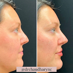 Non-Surgical Rhinoplasty | Rejuvenation MD Aesthetic | Asheboro, NC