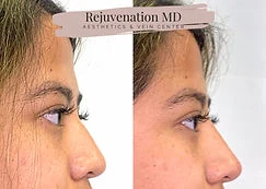 Non-Surgical Rhinoplasty Before-and-after | Rejuvenation MD Aesthetic | Asheboro, NC