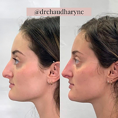 Non-Surgical Rhinoplasty Before-and-after | Rejuvenation MD Aesthetic | Asheboro, NC