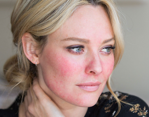 Rosacea | Rejuvenation MD Aesthetic | Asheboro, NC