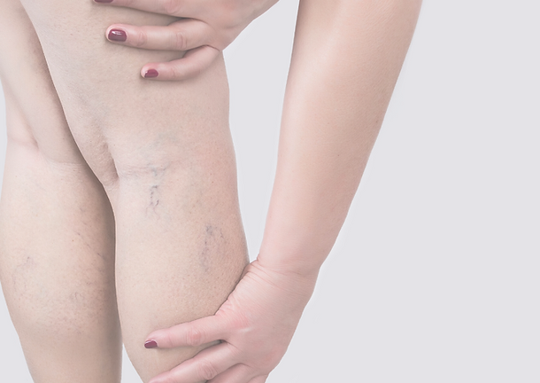 Sclerotherapy Spider Vein | Rejuvenation MD Aesthetic | Asheboro, NC