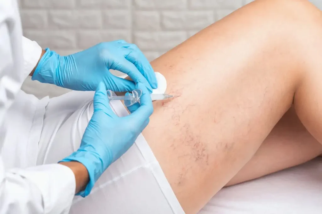 Spider Veins by Rejuvenation MD in Asheboro NC