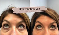 Upper Face Rejuvenation Before-vs-After | Rejuvenation MD Aesthetic | Asheboro, NC