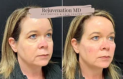 Upper Face Rejuvenation Before-vs-After | Rejuvenation MD Aesthetic | Asheboro, NC