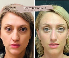 Upper Face Rejuvenation Before-vs-After | Rejuvenation MD Aesthetic | Asheboro, NC