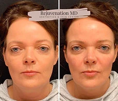 Upper Face Rejuvenation Before-vs-After | Rejuvenation MD Aesthetic | Asheboro, NC