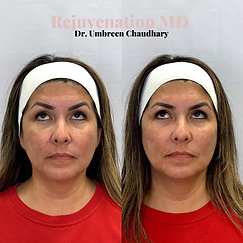 Upper Face Rejuvenation Before-vs-After | Rejuvenation MD Aesthetic | Asheboro, NC