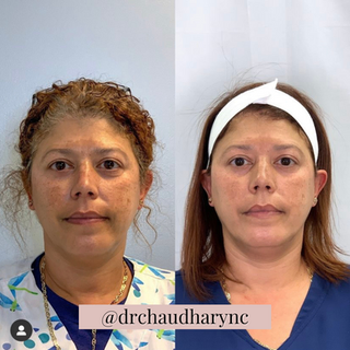 Chemical Peels After and Before Treatment | Rejuvenation MD Aesthetic | Asheboro, NC