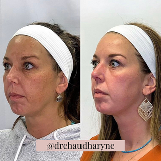 Chemical Peels After vs. Before Treatment | Rejuvenation MD Aesthetic | Asheboro, NC