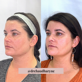 Chemical Peels After versus Before Treatment | Rejuvenation MD Aesthetic | Asheboro, NC