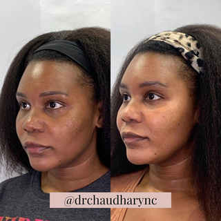 Chemical Peels After vs. Before Treatment | Rejuvenation MD Aesthetic | Asheboro, NC