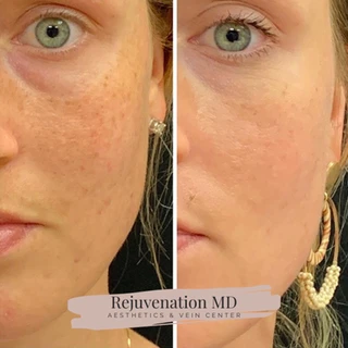 Chemical Peels Before and After Treatment | Rejuvenation MD Aesthetic | Asheboro, NC