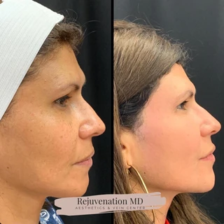 Chemical Peels Before and After Treatment | Rejuvenation MD Aesthetic | Asheboro, NC