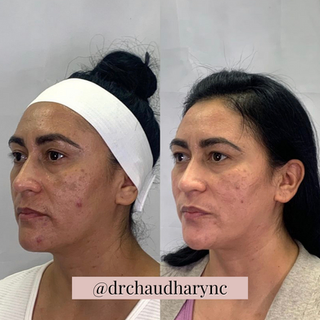 Chemical Peels Before versus After Treatment | Rejuvenation MD Aesthetic | Asheboro, NC