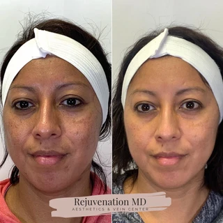 Chemical Peels Before versus After Treatment | Rejuvenation MD Aesthetic | Asheboro, NC