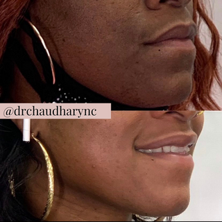 Chemical Peels Before versus After Treatment | Rejuvenation MD Aesthetic | Asheboro, NC