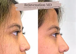 Collagen Growth With Sculptra Before and After Treatments | Rejuvenation MD Aesthetic | Asheboro, NC