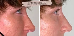 Collagen Growth With Sculptra Before and After Treatments | Rejuvenation MD Aesthetic | Asheboro, NC