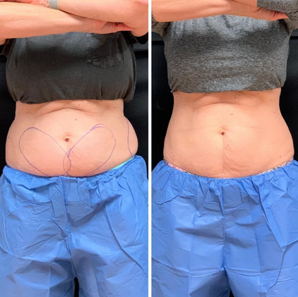 CoolSculpting Treatment Before + Afters | Rejuvenation MD Aesthetic | Asheboro, NC