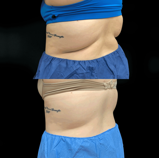 CoolSculpting Treatment Before + Afters | Rejuvenation MD Aesthetic | Asheboro, NC